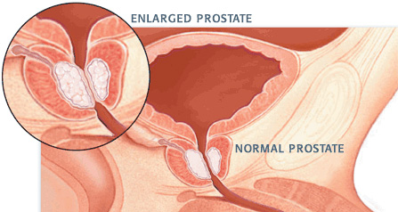 What is Benign Prostatic Hyperplasia (BPH)