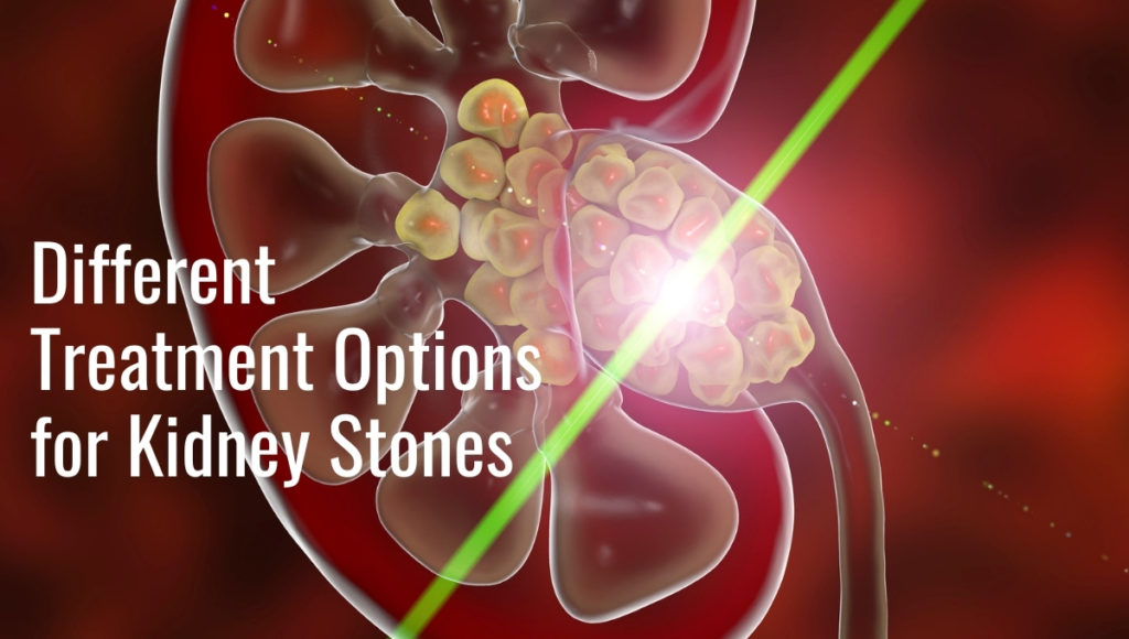 Kidney Stones | Advanced Urology Institute